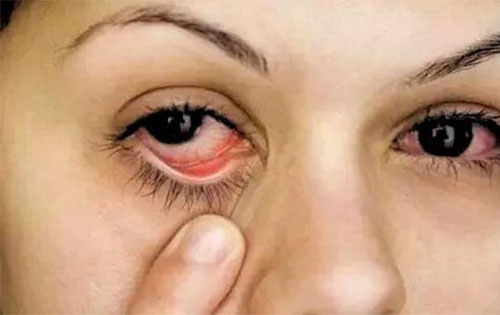 �۾������к�Ѫ˿ԭ�� ȥ�۾���Ѫ˿��С����